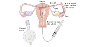 التلقيح داخل الرحم (IUI)