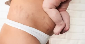 كيف سيكون الحمل بعد عملية شد البطن