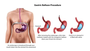 عملية بالون المعدة